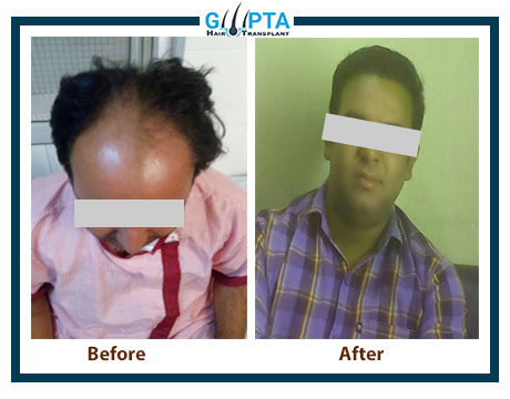 Best hair transplant clinic in ludhiana