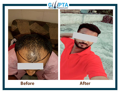 Best hair transplant clinic in ludhiana