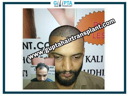 Gupta Hair Transplant – A Permanent Hair Solution